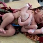 baby-born-with-four-legs-and-three-hands